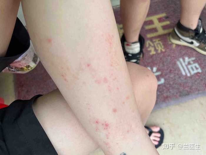 身上突然长了很多小红疹是什么原因？ - 知乎