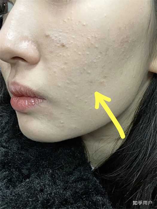 痤疮,痘痘,闭口,粉刺,白头有什么区别? - 知乎