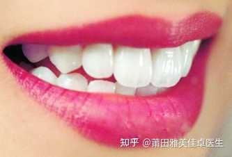 什么是牙齿倒凹? - 知乎