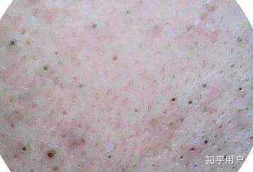 各种皮疹如何区分?例如丘疹、疱疹、荨麻疹、斑疹。 - 知乎