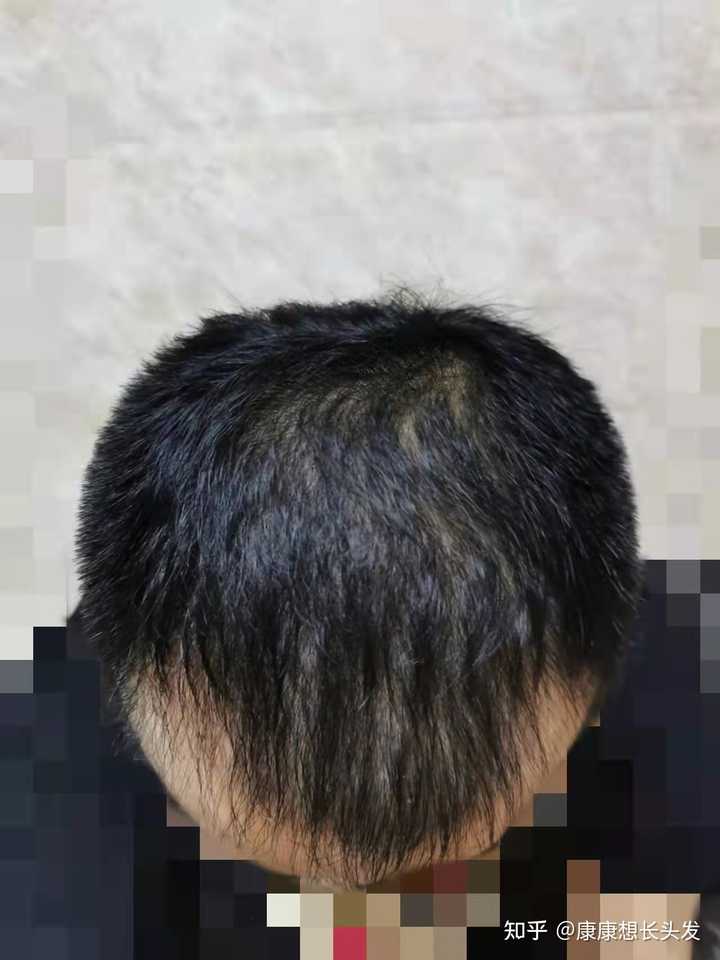 雄激素性脱发有救吗？
