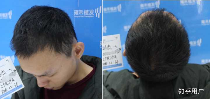 如何使发量变多? - 知乎