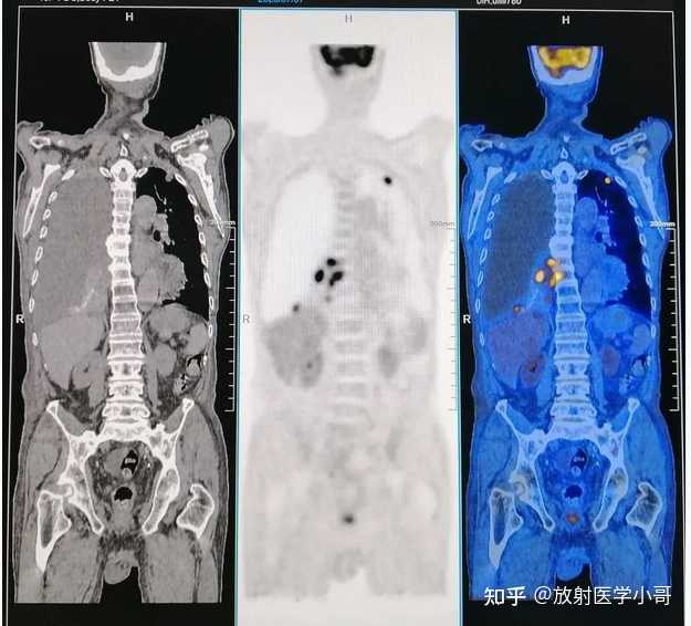 PET-CT主要检查什么? PET-CT检查有什么作用? - 知乎