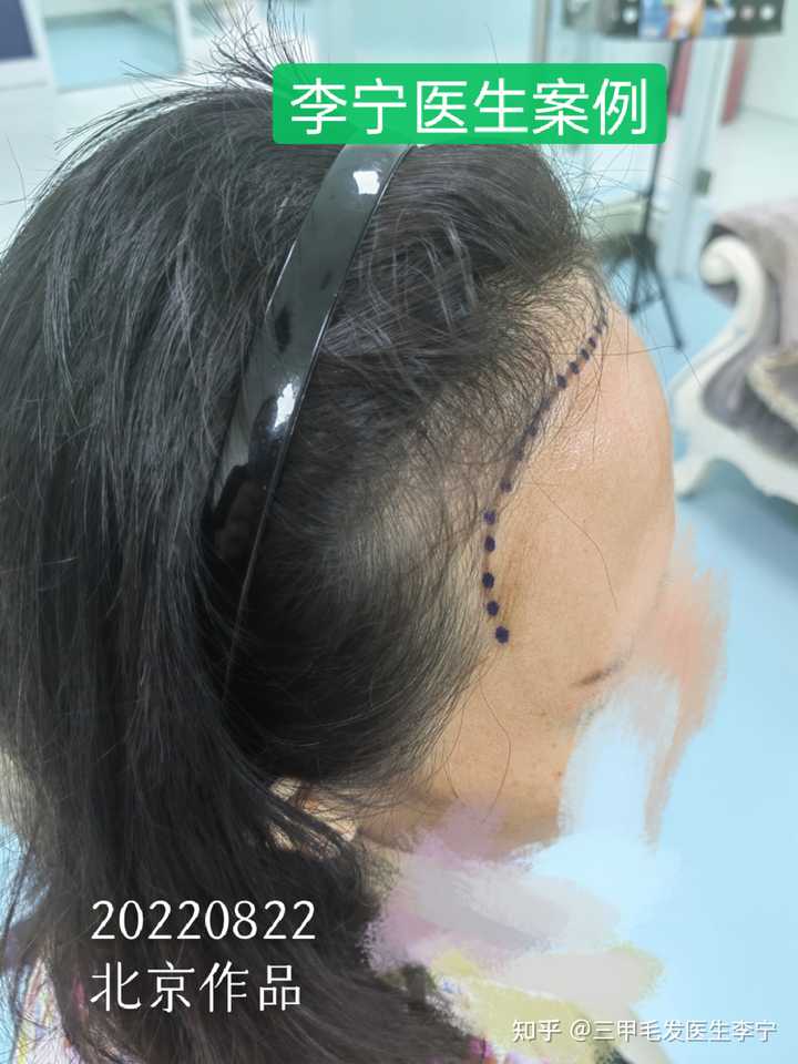 植发后应该如何护理自己的头发啊？ - 知乎