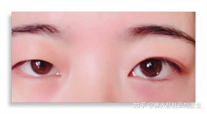 内双与单眼皮割双眼皮有不同吗?一单一双能只做一边吗? - 知乎