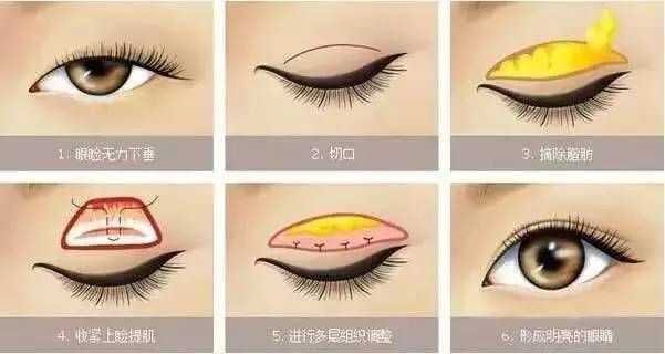 双眼皮的价格_郑大一附院割双眼皮价格_全切双眼皮价格
