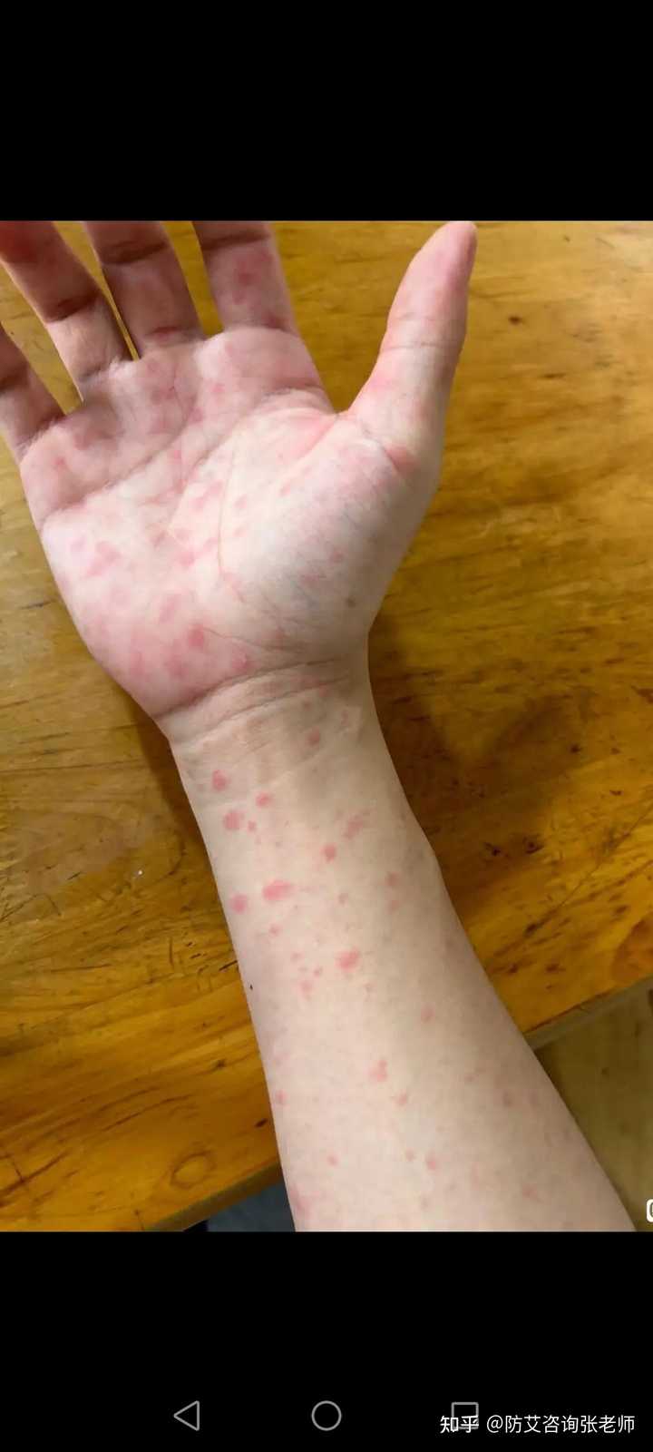 梅毒皮疹和普通皮疹怎样区分? - 知乎