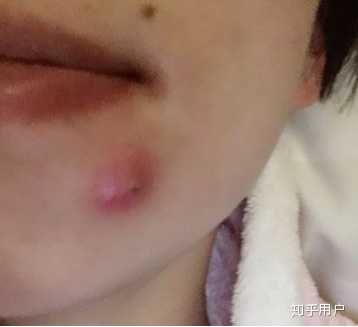 火疖子的病因是什么? - 知乎