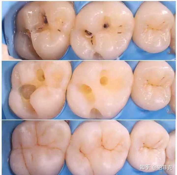 补牙的时候应该注意些什么? - 知乎