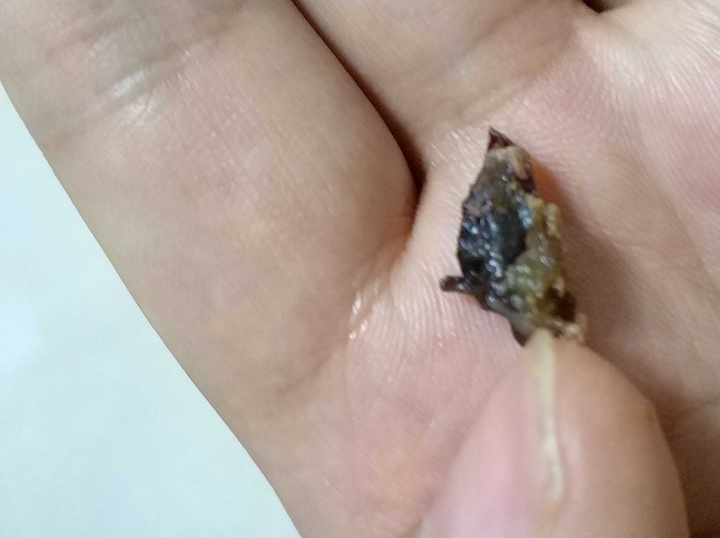人的鼻屎能大到什么程度? - 知乎