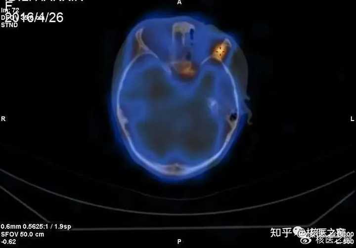 SPECT和PET和CT有什么区别，相比其他两者，SPECT有什么优势？ - 知乎