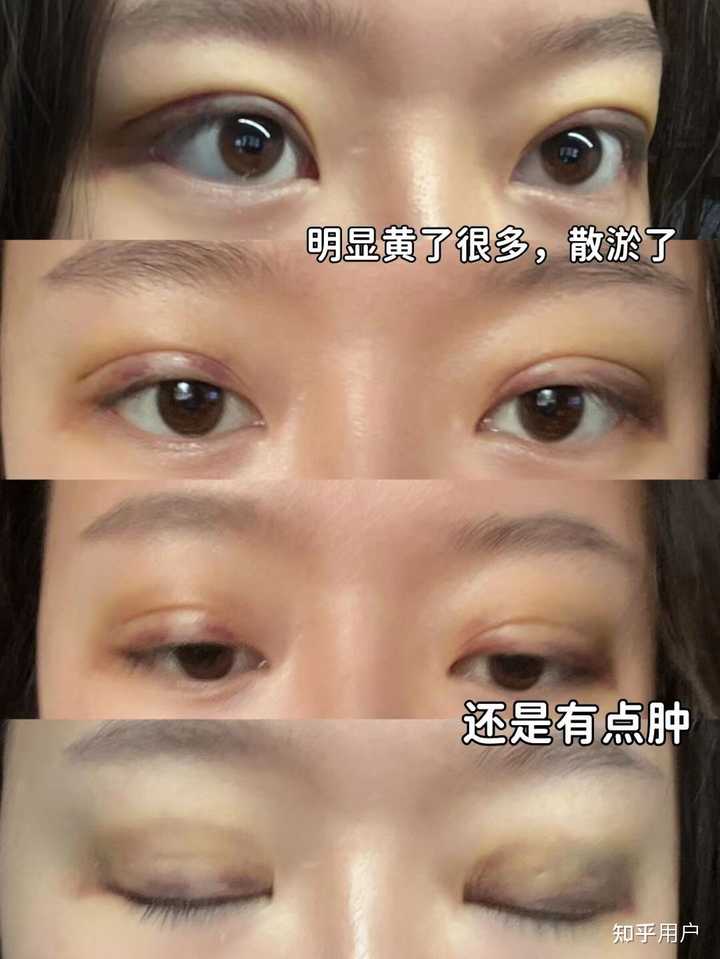 双眼皮埋线价格_双眼皮法埋线价格多少_埋线法双眼皮价格