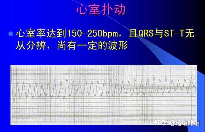 心室扑动与颤动的临床特点有哪些? - 知乎