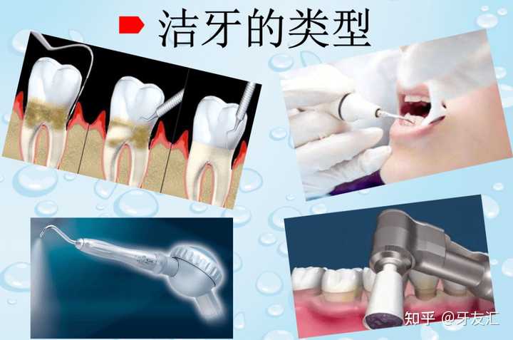 洗牙的过程是怎样的？洗牙后有哪些需要注意的？ 知乎 