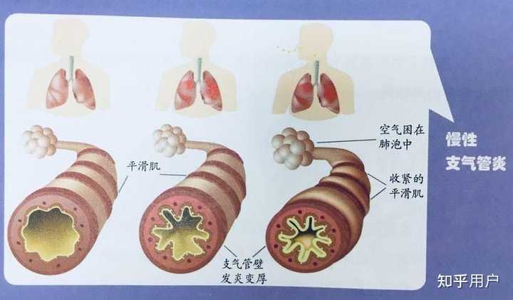 咳嗽气短是什么原因导致的？ - 知乎