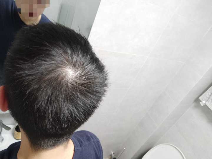 发旋处头发太少了！！！，我是不是要秃了，怎么办啊！？ - 知乎