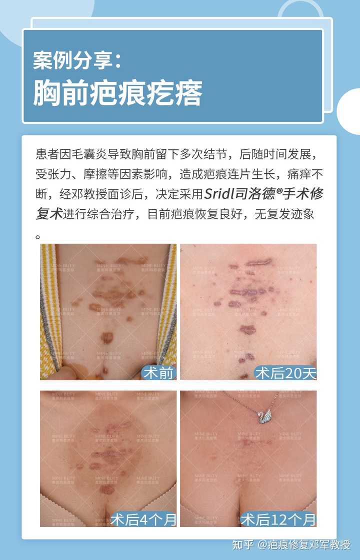 为什么胸前容易长瘢痕疙瘩? - 知乎