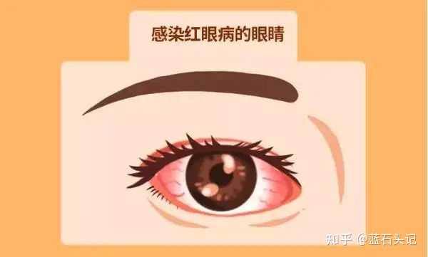 红眼病有哪些表现?致病原因是什么?该如何预防和治疗呢? - 知乎