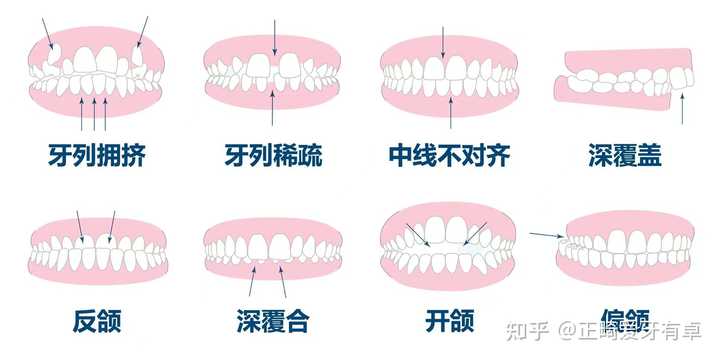 如何治疗牙列不齐? - 知乎