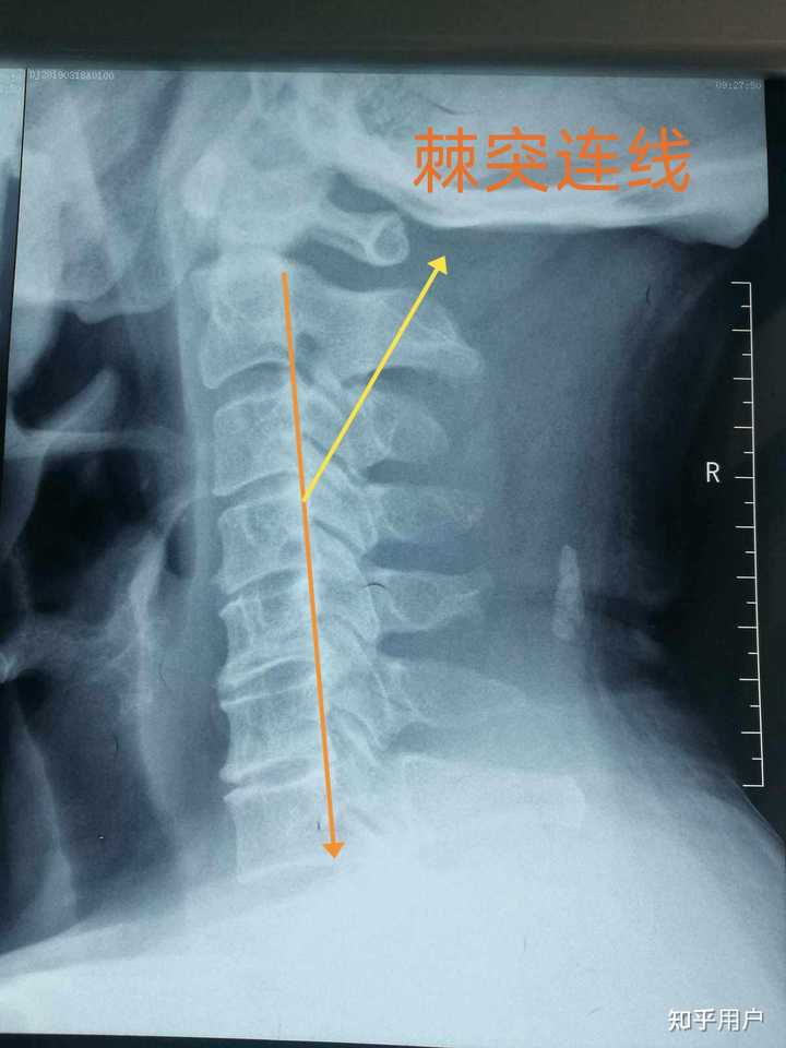 如何区分颈椎反弓图片和正常图片? - 知乎