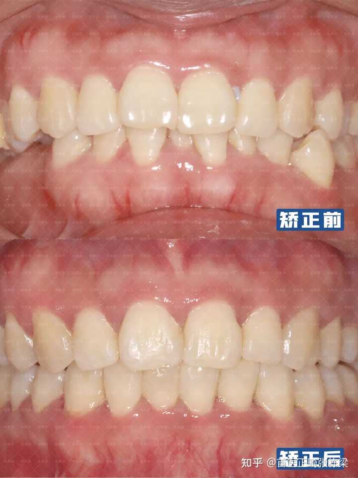 如何确定是否偏颌,以及偏颌的性质? - 知乎