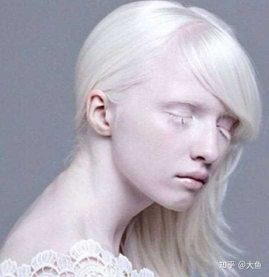 有哪些生活习惯会导致白化病？ 知乎 