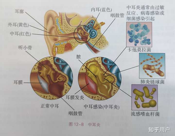 早期中耳炎有哪些症状？ - 知乎