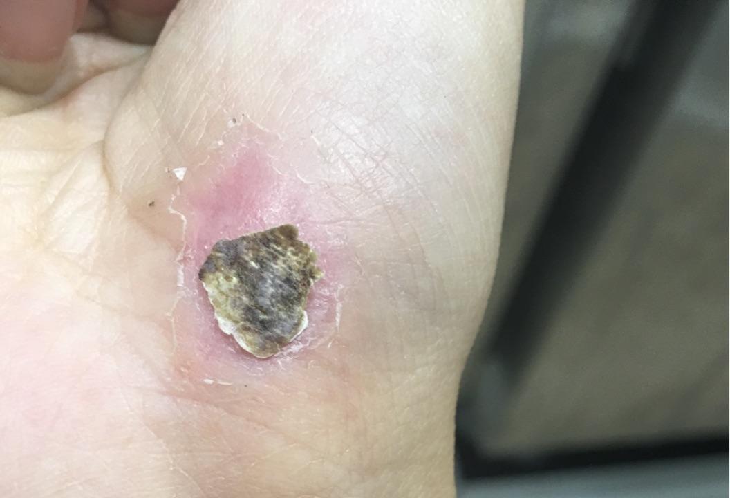 皮肤破后流血结痂愈合是一个怎样的过程