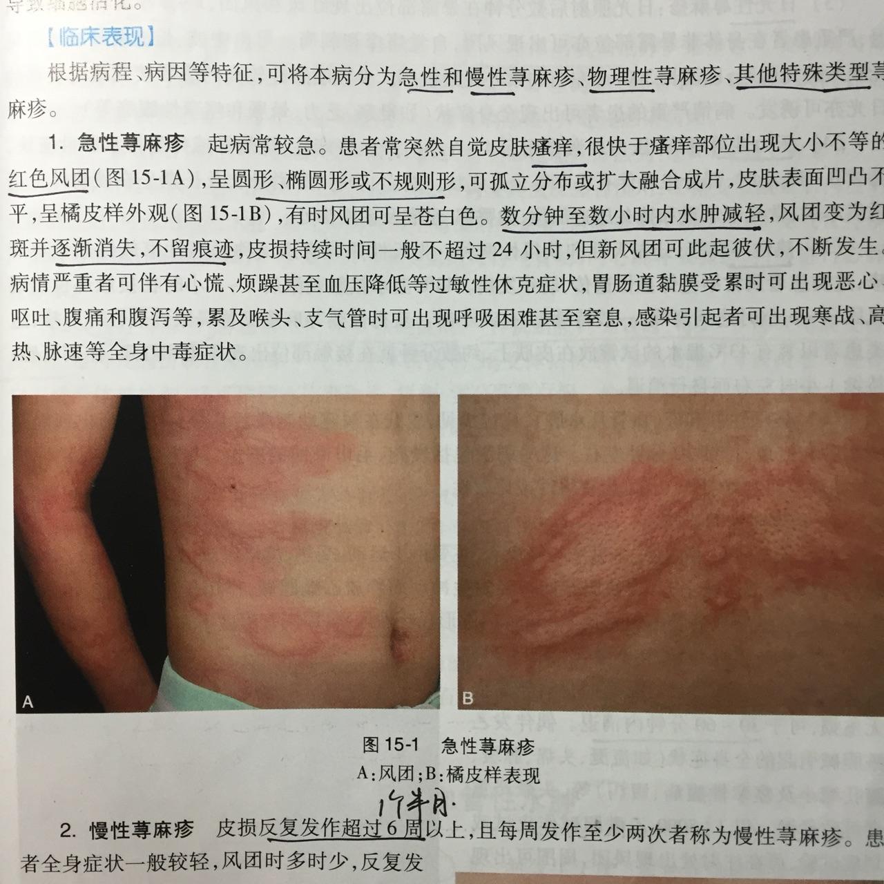 各种皮疹如何区分?例如丘疹、疱疹、荨麻疹、斑疹。 - 知乎