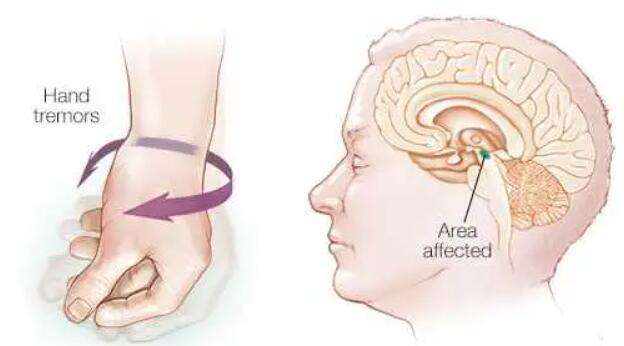 Biến chứng của chứng đau nửa đầu: Bệnh Parkinson PD