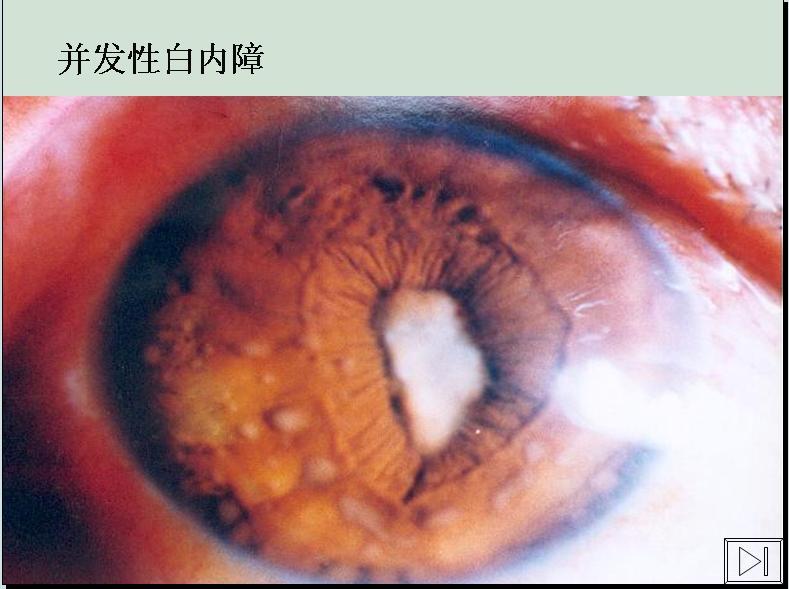 历史上的重瞳子是真实存在的吗?两个瞳仁在眼睛里是如何分布的? - 知乎