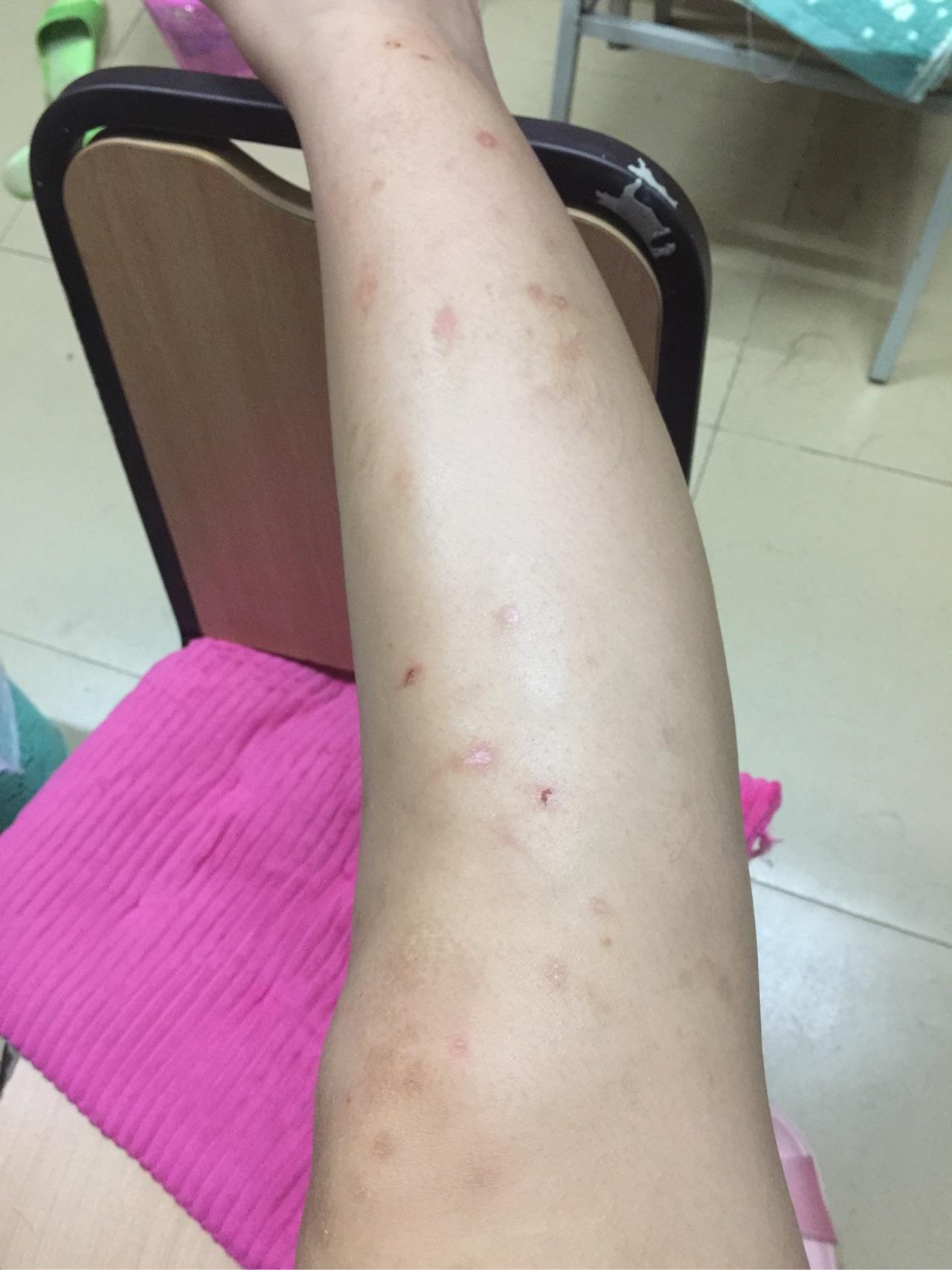我的腿被蚊子咬得体无完肤带图怎样有效地消除蚊子印