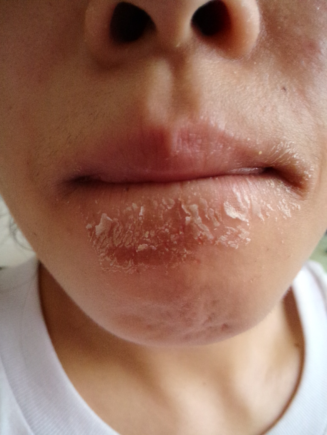 脸上长湿疹了怎么办