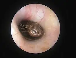 因为耳屎过多,你有发生过什么有趣的事?