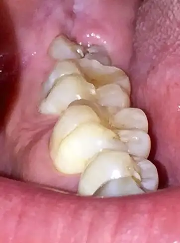 长了一颗智齿(牙齿部分没有全露出来,大部分在牙龈里)要拔吗?