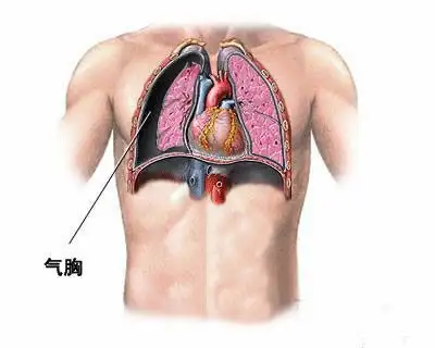 上厕所过于用力会导致气胸吗