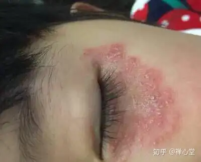 脚气会传染到嘴上吗?为什么? - 知乎