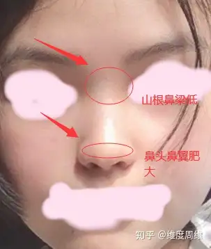 想知道鼻孔外露该怎么解决?