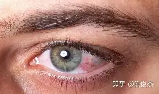 眼睛发红可能是什么原因造成的? - 知乎