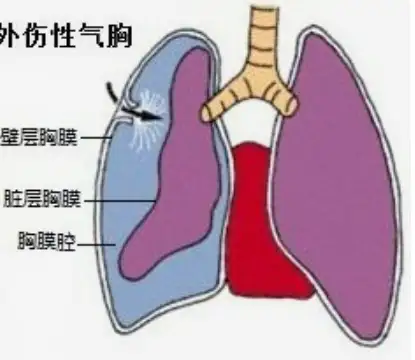 开放性气胸图片解释图片