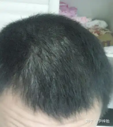 只是发际线高额头两边有点秃可以用米诺地尔吗