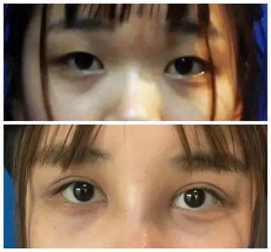 开外眼角有什么不好吗