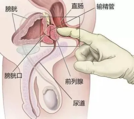 贵阳东大肛肠医院：因尴尬而拒检？令人羞耻的“肛门指检”，到底该不该做？