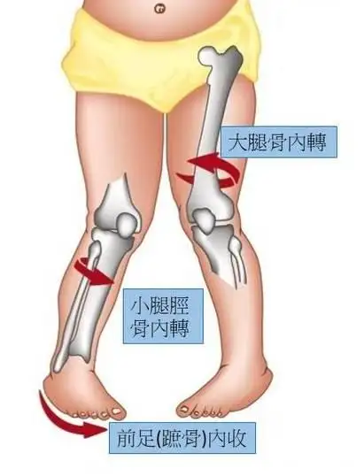 膝外翻一定伴隨著足內翻嗎該怎麼矯正可以做哪些訓練呢感謝各位的回答