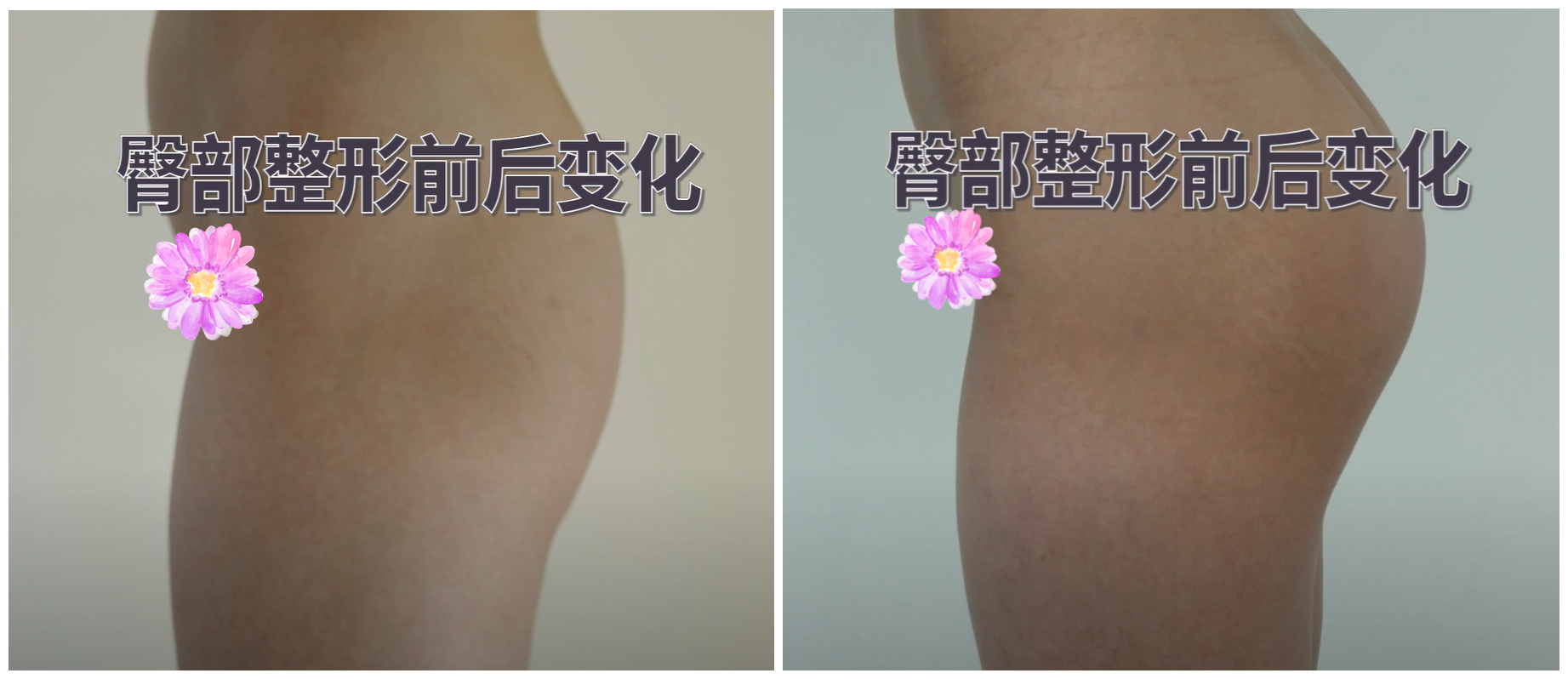 臀部整形名整探 的想法: 臀部两侧凹陷,可以通过自体脂肪移植来填