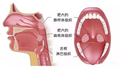 苏州儿童医院李大伟医生：专业领航，解决小儿扁桃体肥大困扰