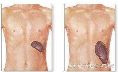 充血性脾肿大的症状都有些什么? - 知乎