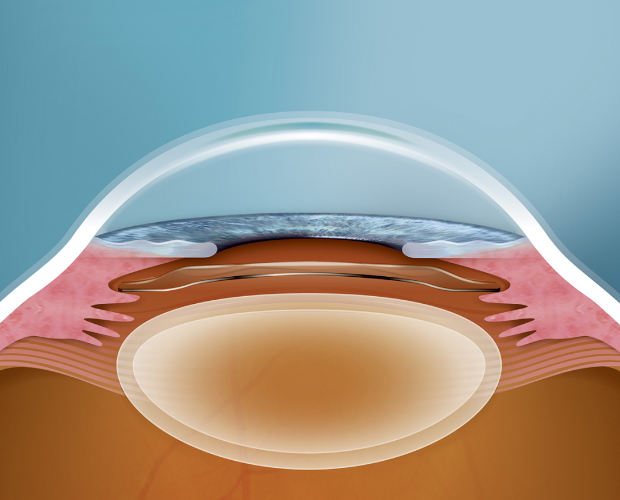 爱尔眼科ICL晶体植入术多重优势，帮助患者矫正近视