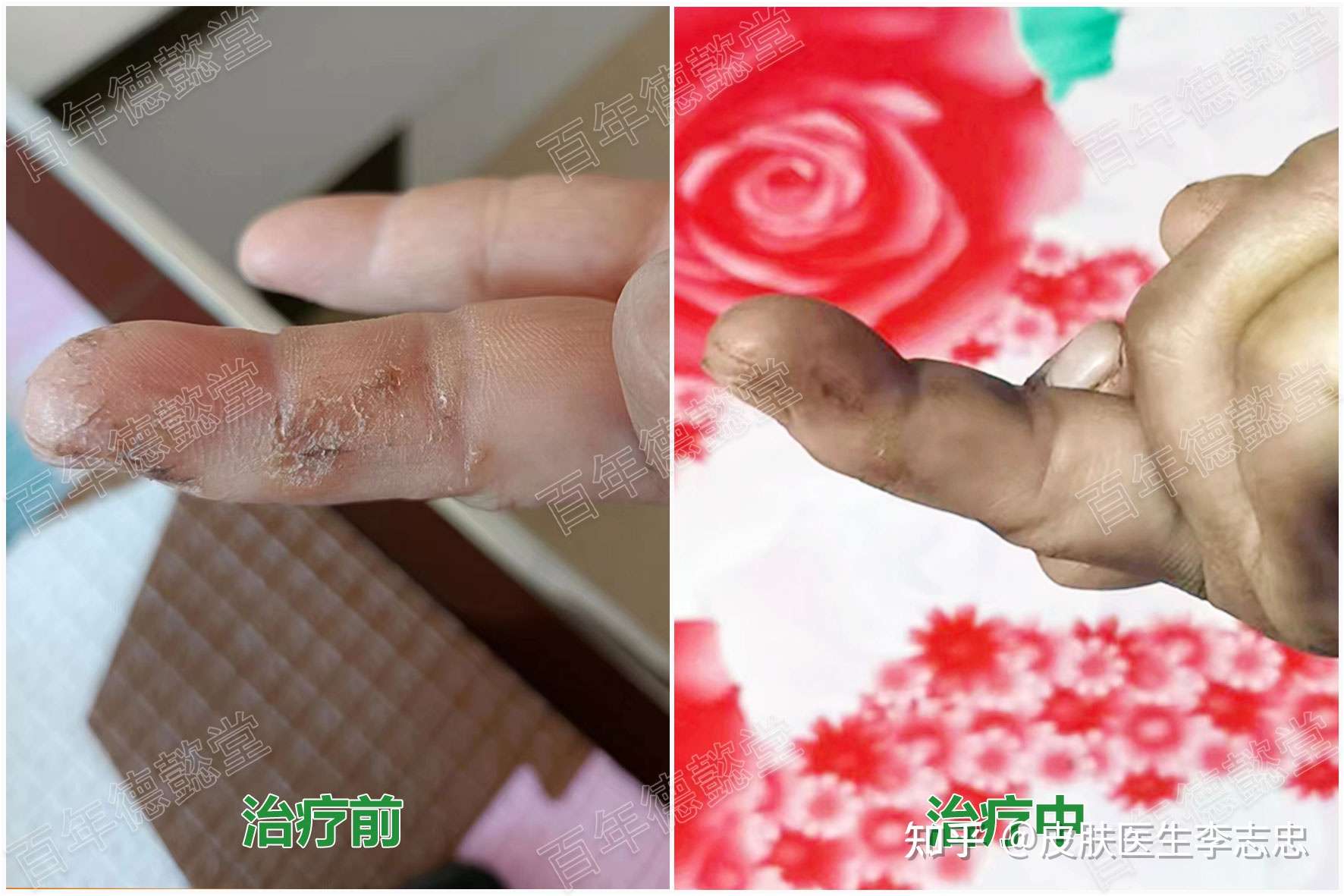 皮膚醫生李志忠 的想法: 手指皸裂性溼疹,用藥後漸好,很高興! - 知乎