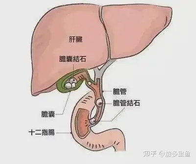 胆囊结石伴胆囊炎的表现症状有哪些?